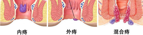 痔疮的最佳治疗方法